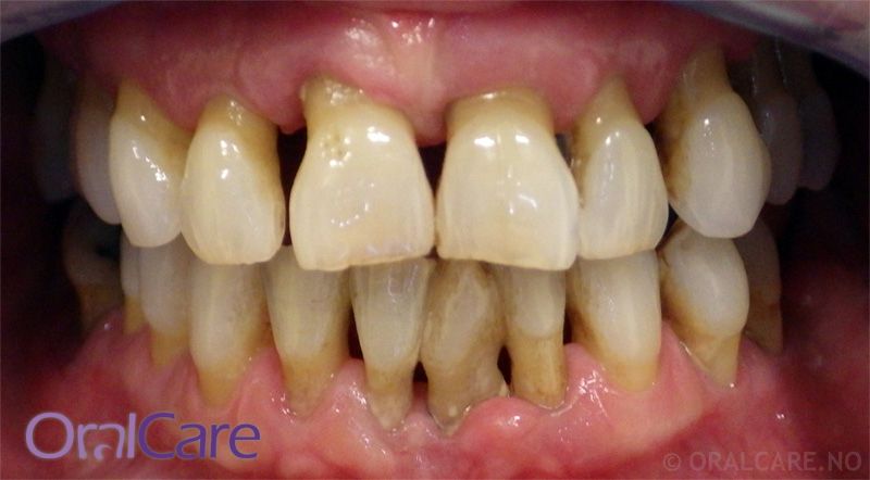 Tenner der tannkjøttet har trukket seg tilbake på grunn av bentap ved periodontitt