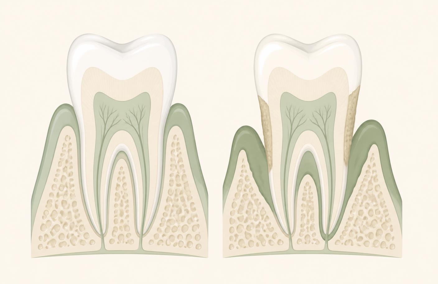Illustrasjon som sammenligner frisk tann med tann rammet av periodontitt